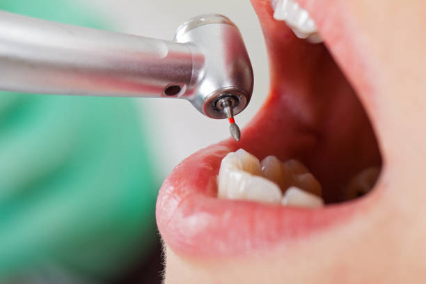 Best Emergency Tooth Extraction in Sullivan, IN